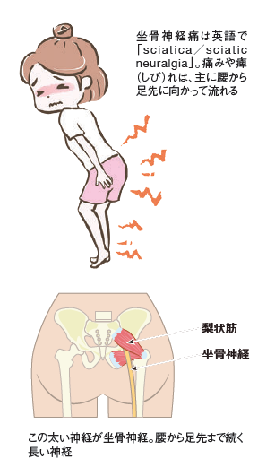 坐骨神経痛って何？ 病気？ 症状？（前編） - ニューヨークで生活する